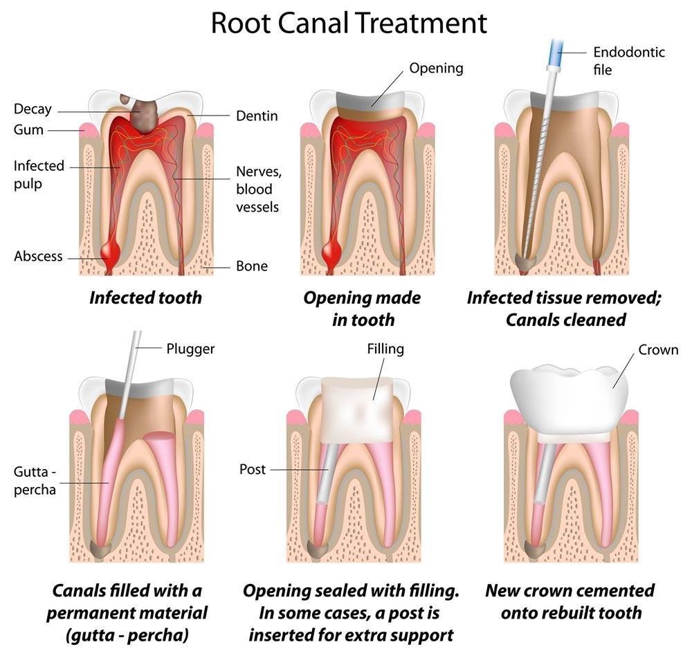 how-long-after-root-canal-to-get-crown_1753688400