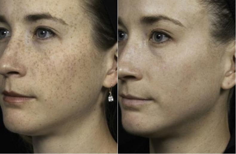 how-much-does-fraxel-laser-cost_1753688601