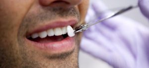 How to Care for Your Veneers for Long-Lasting Results?