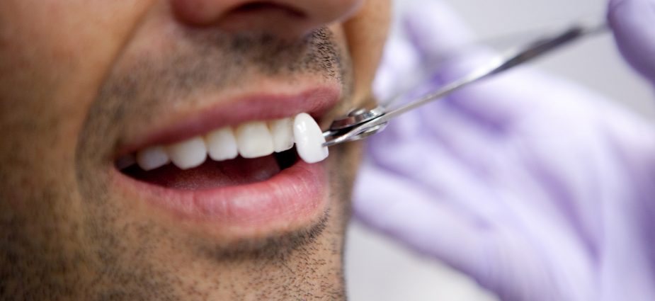How to Care for Your Veneers for Long-Lasting Results?